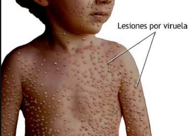 monkeypox cases in europe in telugu
